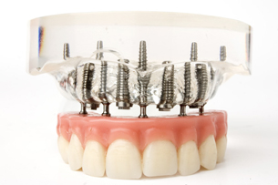 Implantati